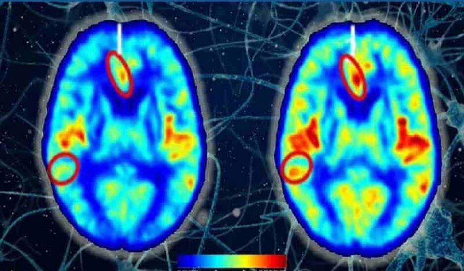 Ressonância magnética mostra fluxo sanguíneo antes (à esquerda) e depois (à direita) em participantes humanos tratados com oxigenoterapia