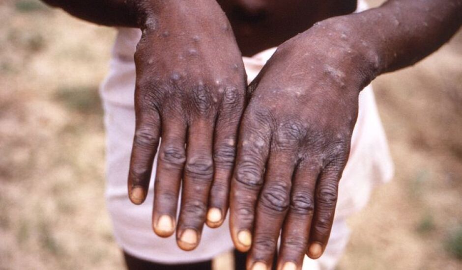 Doença, originária da África, provoca lesões na pele