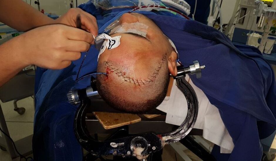Paciente apresentou três aneurismas cerebrais e passou por uma embolização de aneurisma e depois por microcirurgia para clipagem