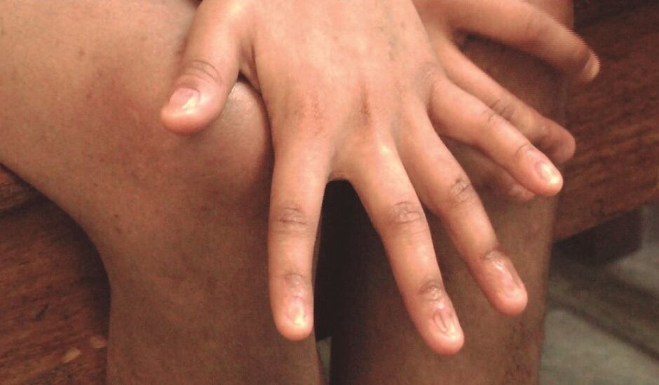 Manchas nas pernas e braços e distrofia nas unhas são bastante característicos na patologia