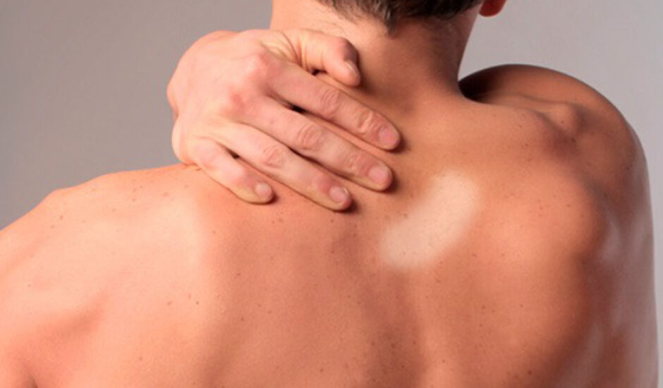 Manchas na pele podem ser sinal de Hanseníase, que se manifesta na pele e nos nervos