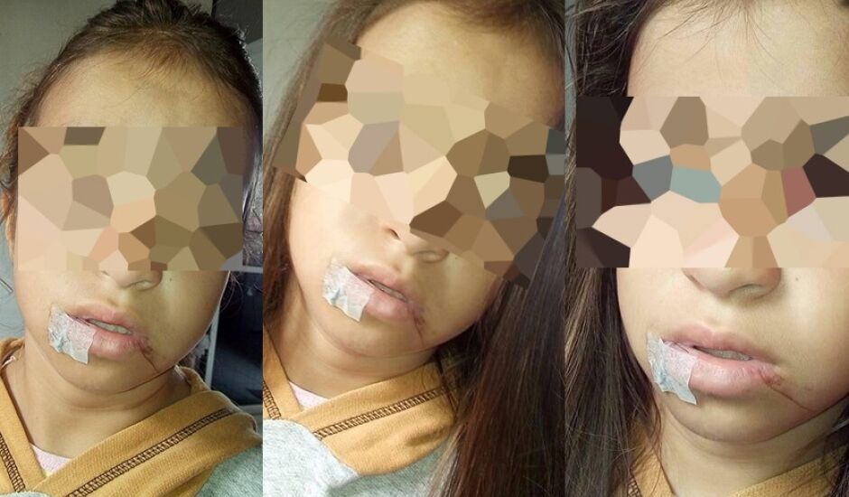 Adolescente sofreu corte na boca e escoriações no rosto ao ser atingida por linha de pipa chilena
